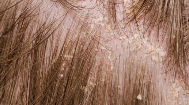 People with this kind of dandruff usually have drier hair and notice a tightness in their scalp.