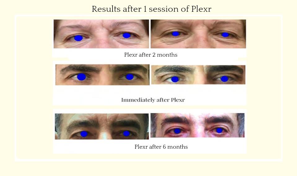 Figure 8: Photo presentation of before and after of non-surgical blepharoplasty.