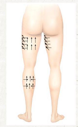 Tights /Claves Obesity Tights Combined with high- frequency massage and Carboxy therapy, result is highly effective.