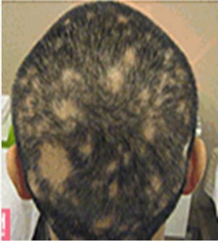 Hair loss Use 30G 2.5cm Treat 1~1.