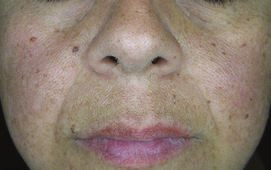 IN-OFFICE PROFESSIONAL PEEL TREATMENT For Aging Skin
