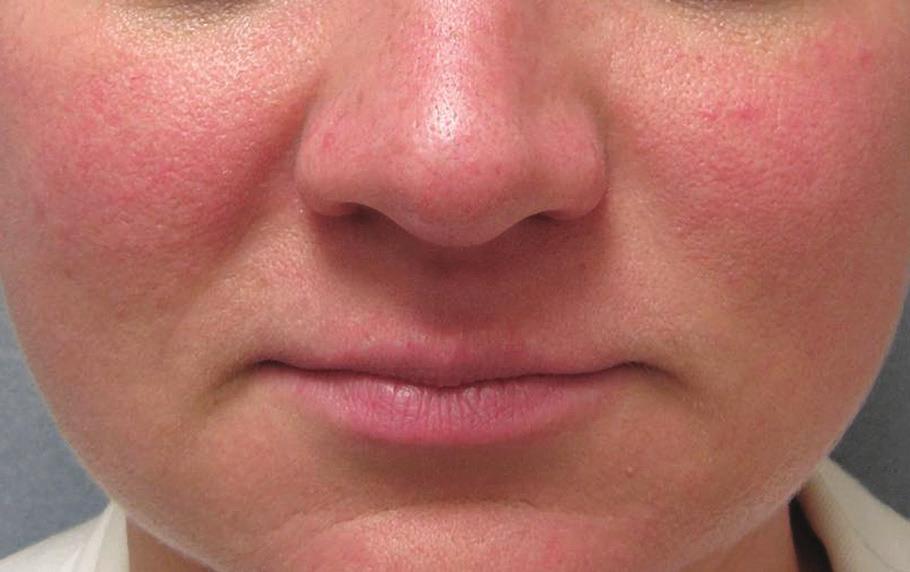 IN-OFFICE PROFESSIONAL PEEL TREATMENT For Intermittent or Permanent Redness