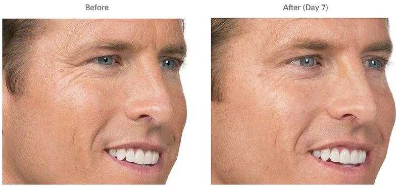 Botox can also be used for a wide variety of other conditions, including migraines, excessive sweating, and psoriasis.