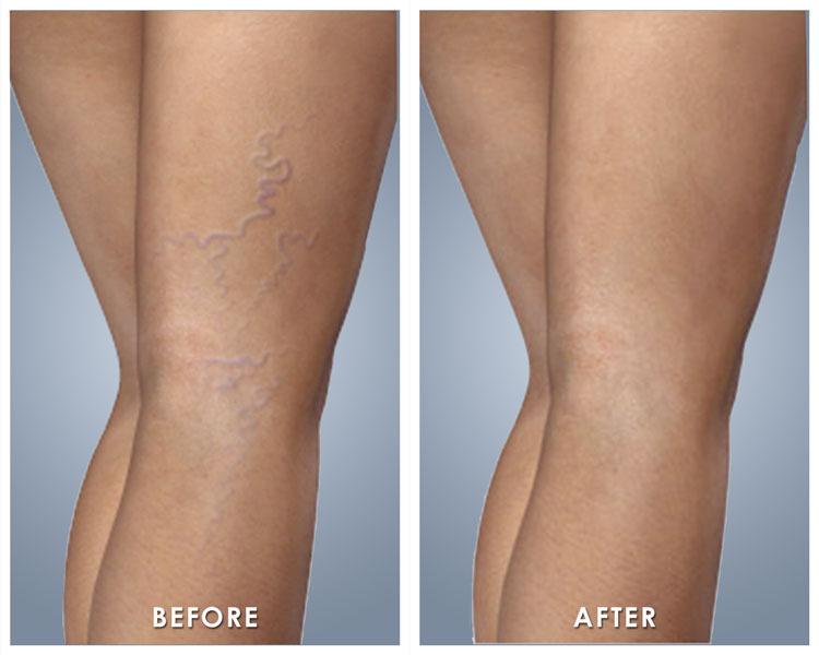 SPIDER VEIN TREATMENT BEAUTY NATURAL GLOW $100 for first vial, $75 each vial after Who wears short-shorts!