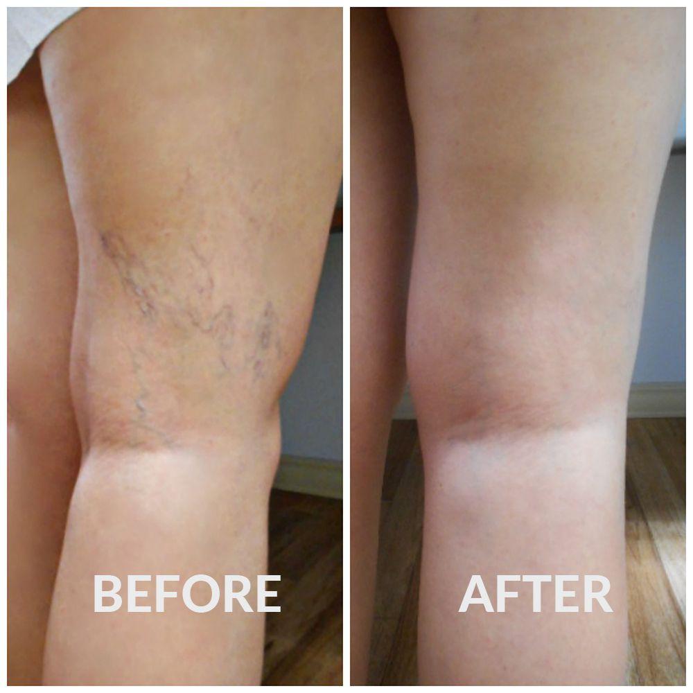 Spider veins are small, dilated blood vessels that are not required for your circulation, so they can safely be eliminated with sclerotherapy.
