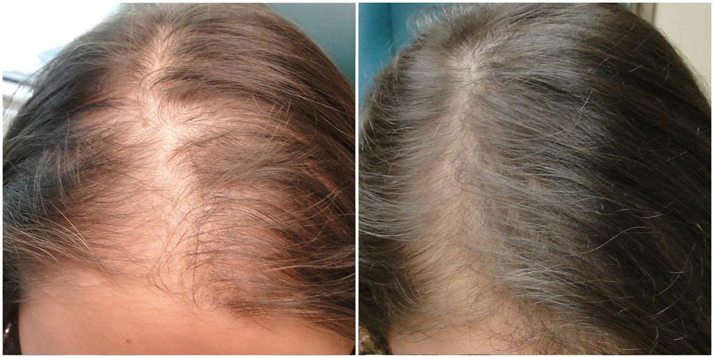 PRP THERAPY BEAUTY NATURAL GLOW PRP For Hair Loss - $400 Per Session FOR MEN & WOMEN PRP stands for platelet-rich plasma. Our blood is made of two main components, red blood cells and plasma.