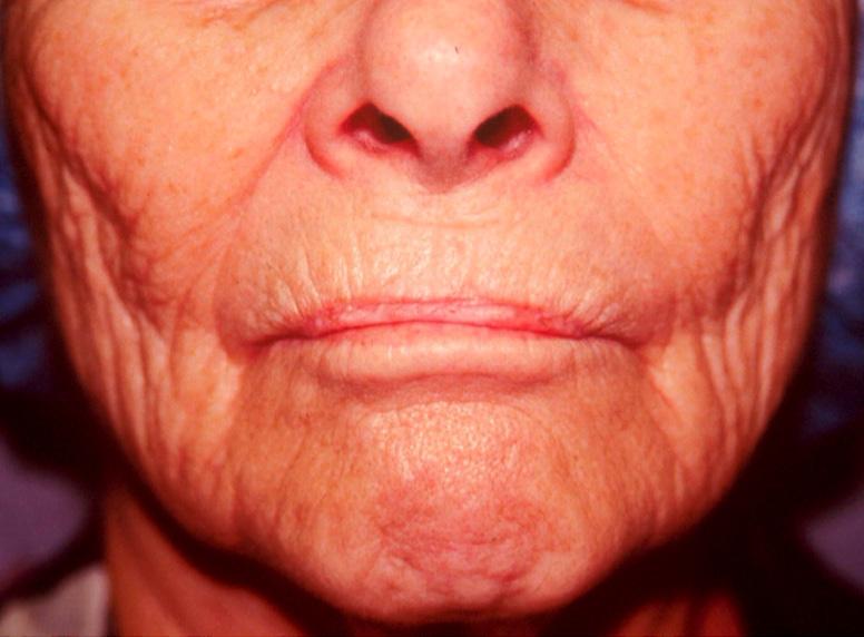 Lengthening of the cutaneous upper lip, volume loss, and