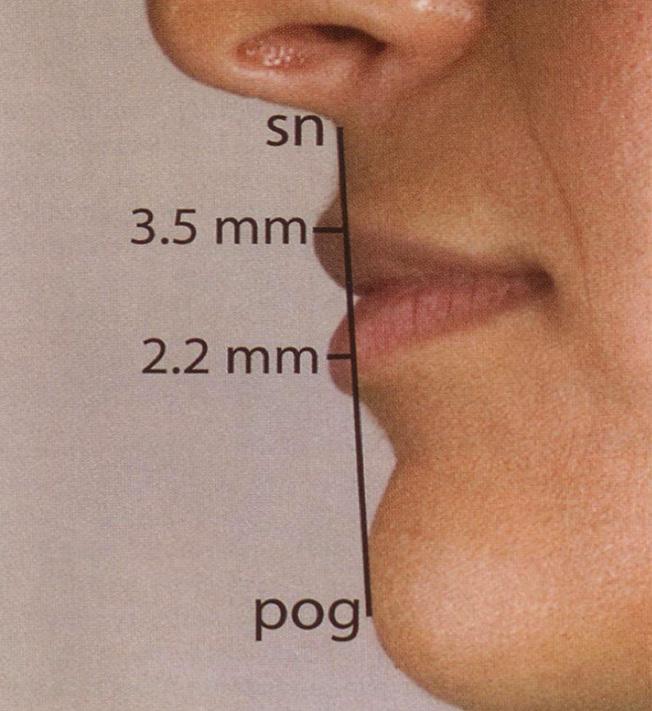 The lower third of the face is also divided vertically into thirds: upper third corresponding to the upper lip and the lower two thirds corresponding to the lower lip and chin.