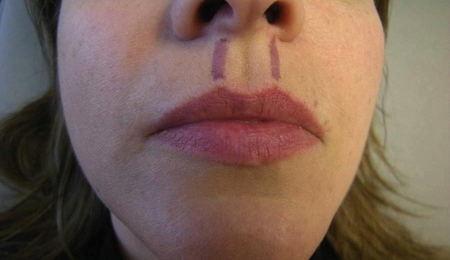 1086 FIGURE 13. Create philtrum columns. FIGURE 14. Create Cupid s bow. FIGURE 15. Define the vermilion-cutaneous junction in the medial aspect of the lateral subunit.