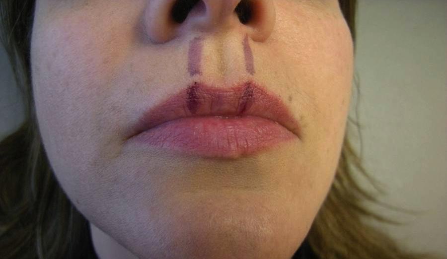 12 The medial subunit of the upper lip extends from the midline to the philtrum column; the lateral subunit extends from the philtrum column to the oral commissure and nasolabial fold. Inject ~0.
