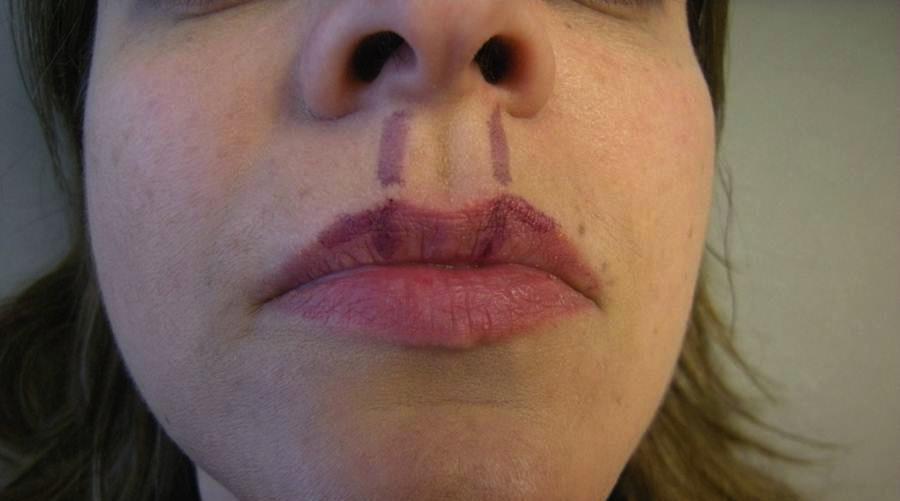 It is important not to augment the vermilion-cutaneous junction along the entire lateral subunit, but only in its medial aspect (Figure 15). vertical injection of filler into each philtrum column.