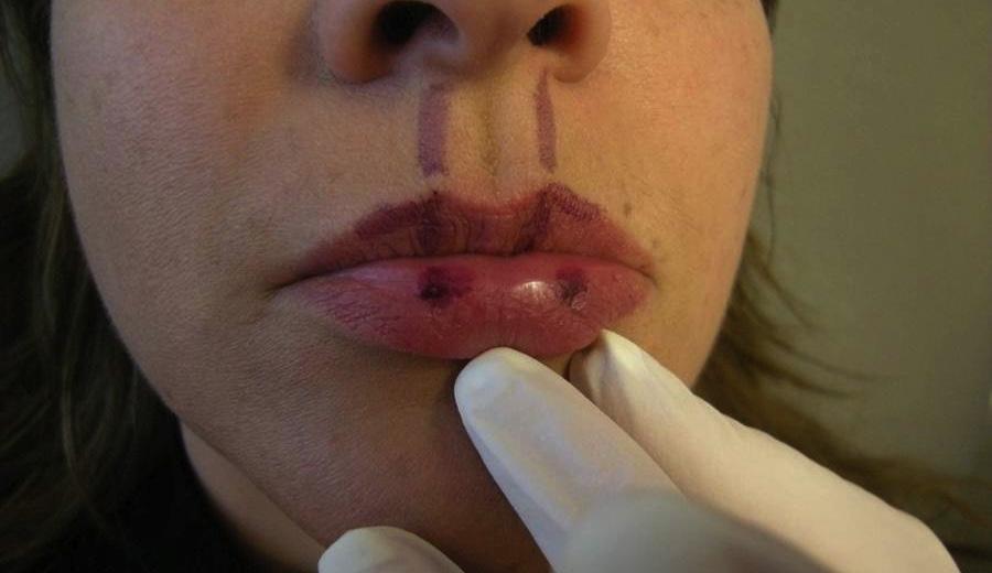 1087 FIGURE 16. Create lower lip tubercles. FIGURE 17. Support the oral commissures. FIGURE 18. Evert the upper lip by filling the upper aspect of the nasolabial creases.