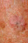 Recogizig ski cacers ACTINIC KERATOSIS A commo type of su-related ski damage is actiic keratosis, also kow as solar keratosis. Actiic keratosis lesios ca vary i color from flesh toe to reddish brow.