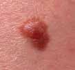 BASAL CELL CARCINOMA The majority of ski cacers are basal cell carciomas, typically foud o areas exposed to the su, such as the head ad eck.
