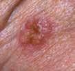 Oce treated, a basal cell carcioma may retur. For this reaso, those who have these cacers treated should perform frequet self-exams ad have a dermatologist examie them regularly.