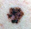 ATYPICAL MOLE: DYSPLASTIC NEVI This uusual type of beig mole ca sometimes resemble melaoma.