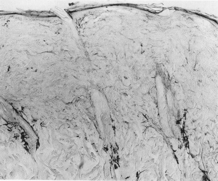 Elastic fibers adjacent to the hair follicles seen in the middle corium