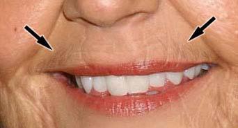 For some strange reason they lose it in the brow area and grow it back around the mouth area.