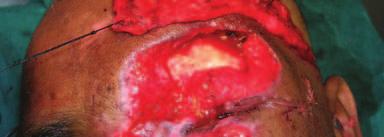 2: Post debridement picture of patient. Fig. 3: Harvested TP fascia.