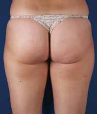 Cellulite and Body Shaping WITH Asclepion Acoustic Waves System AW AW Asclepion s new Acoustic Waves System provides non-invasive cellulite treatment for thighs and