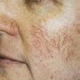freckles, age/ liver spots and other pigmented lesions using laser and light based