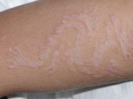 S. Prcic et al. Figure 1. Bizarrely shaped allergic contact dermatitis after temporary henna tattoo on the upper arm. Figure 2.