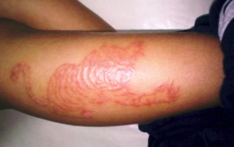 Henna tattoo contact dermatitis a report of four cases and brief review of the selected literature Figure 3. Acute allergic contact dermatitis on the tattoo site of an 8-year-old boy. Figure 4.
