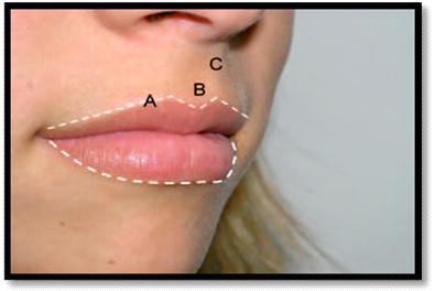 Figure 1: The upper lip is smaller than the lower lip and represents one-third of the total lip volume. (Courtesy- Niamtu J, Compendium 1 ) Figure 2: Defining features of esthetic lips.
