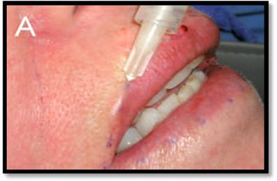 This can be done in addition to white roll augmentation or as an isolated procedure.