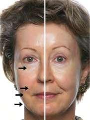 UNTREATED TREATED* Results after 1 treatment