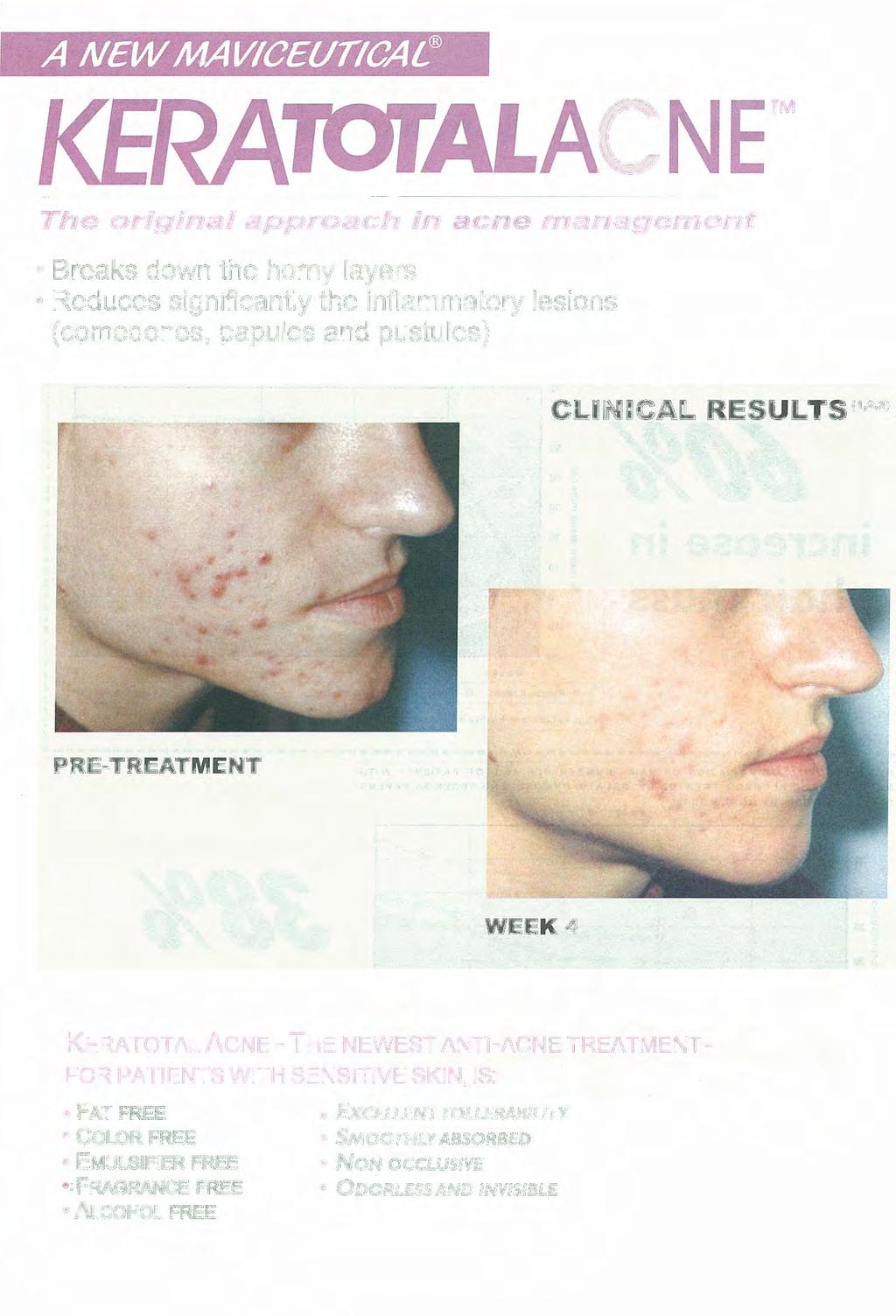 A NEW MAVICEVTICAL The originai approach in acne rnanagernent Breaks down
