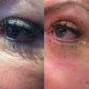 FibroBlast Treatment Purebeau Fibroblast is a revolutionary permanent eye lift procedure that requires no surgery. It tightens and lifts the skin around the eye area with instant results.