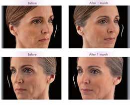 Dermal Fillers Cheek Augmentation (Liquid Face-Lifting) Replacing volume loss to the cheeks and underneath the eye area.