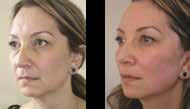 Thread Lift Before and After Lower Face Elionce is a premium thread treatment which uses polydioxanone to create a natural, fresher and younger looking face.