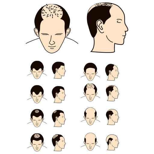 Clinical assessment VOLUNTEERS 26 men aged 18 to 70 years old Brown to dark hair Qualified for a grade 3 to 4 alopecia (Norwood scale) With minimum 150 hair/cm 2 and 40 telogen hair/cm 2 I II