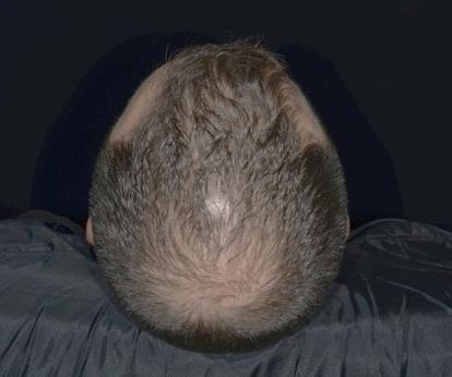 the bald area