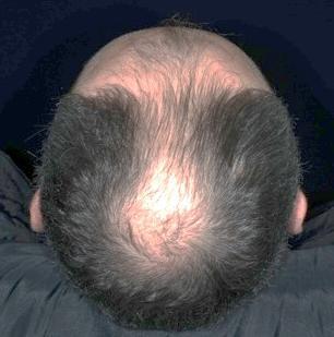per month on the scalp + 8,600 hairs AFTER Hair