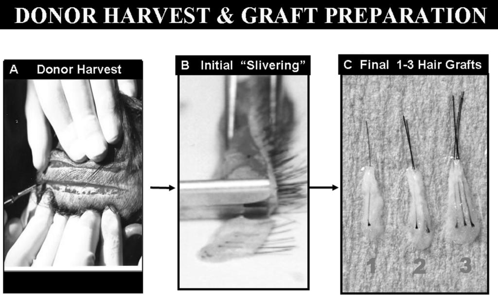 182 Shapiro et al. FIGURE 3 Donor harvest and graft preparation. (A) Harvesting donor hair with single blade as single strip. (B) Slivering donor strip under the microscope.