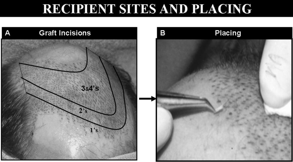 Hair Transplantation 183 FIGURE 4 Recipient incisions (A) are made with a tiny needle in a natural pattern that selectively distributes the 1-hair grafts peripherally and the larger grafts more