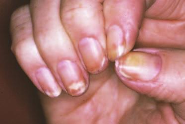 Note that nail yellowness among women who frequently paint their nails likely results from staining or discoloration produced by nail enamel dyes.
