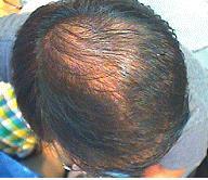 Gender / Age : M / 29 Program : Detox + Hairloss care Homecare: Moin shampoo, Moin tonic, Repairing