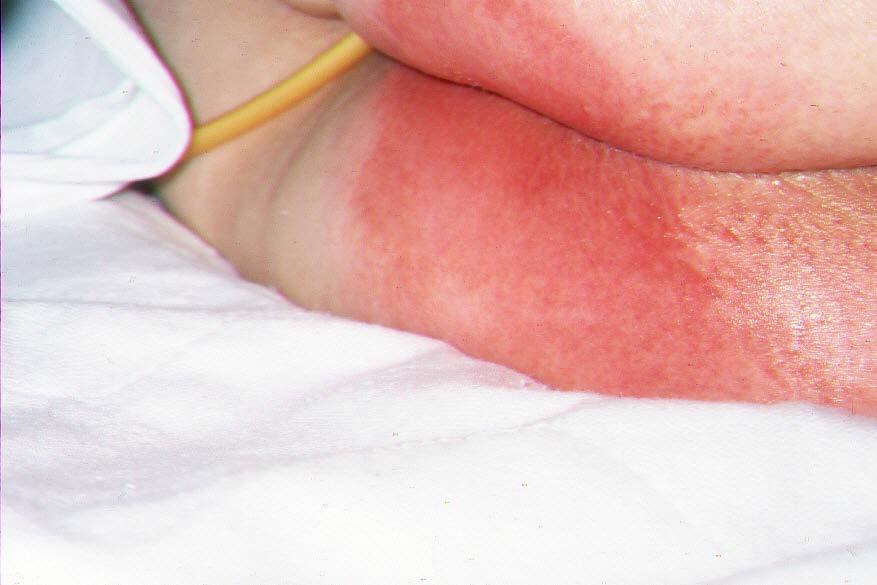 IAD: Diagnosis Inspect the skin for erythema,