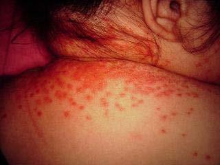 IAD Treatment: Secondary Complications Candidiasis Topical antifungals are effective for the treatment of cutaneous infections Effective agents include the polyene