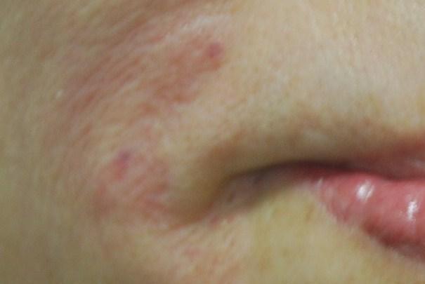 5% injection into the wrinkles on the nasolabial folds and
