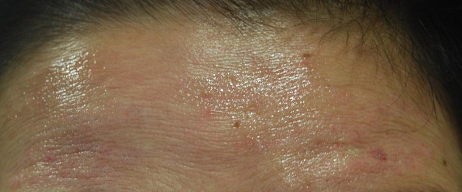 botulinum toxin injection into the forehead