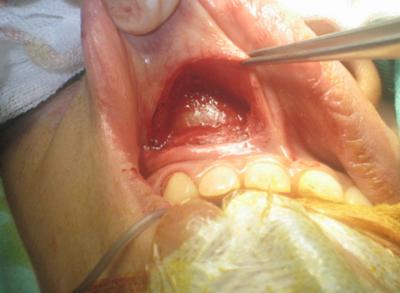 Figure 4 Figure 3: Intraoperative finding of right nasolabial cyst. region and nasal cavity. In the majority of cases, one should be able to diagnose it on clinical assessment.