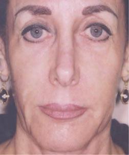 Figure 1 shows a 62-year-old woman before and 4 years Before (a) after treatment with injectable PLLA (reconstituted with 5 ml of sterile water for injection [SWFI] plus 1 ml of lidocaine) to the