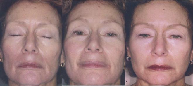 Figure 2 shows a 54-year-old woman before (a) and after (b) treatment with four sessions of injectable PLLA at 1-month intervals (SWFI 5 ml + lidocaine 1 ml) to correct nasolabial fold wrinkles,