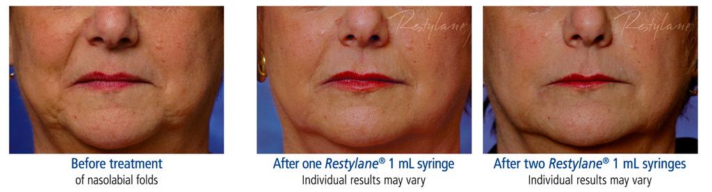 Are you ready to radiate this holiday season? The answer is just a few injections away...spotlight on Restylane It's a part of life our skin changes as we age.