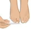 Trimming the corner of a toenail, if done properly, does not cause an ingrown toenail.